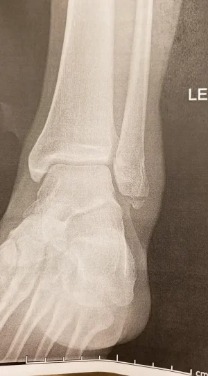 Ds fracture.webp
